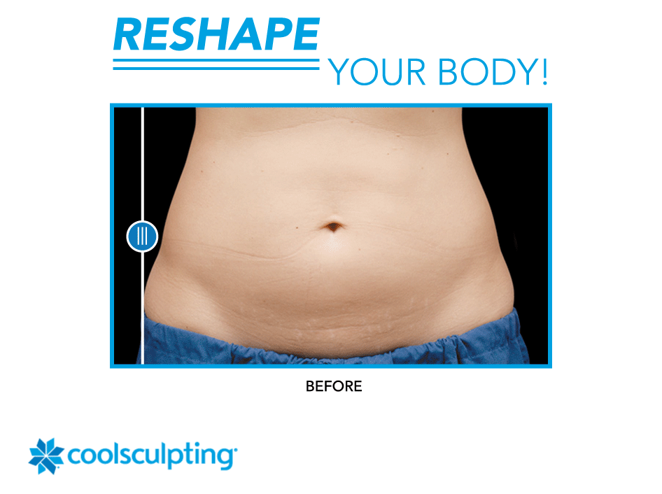 Reshape Your Body with CoolSculpting in Michigan