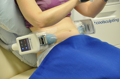 Michigan CoolSculpting Services to Freeze Away Fat
