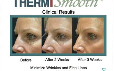 How Long Until I See Results With ThermiSmooth?