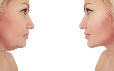 Getting Rid of Stubborn Chin Fat with CoolSculpting; Body Sculpting MI