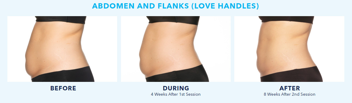 CoolSculpting-Elite-for-the-Aabdomen-and-Flanks-love-handles