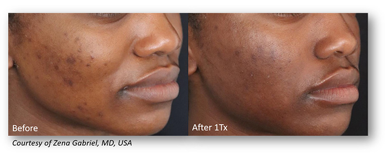 Before-and-After-picture-of-Genius-Microneedling-Treatment