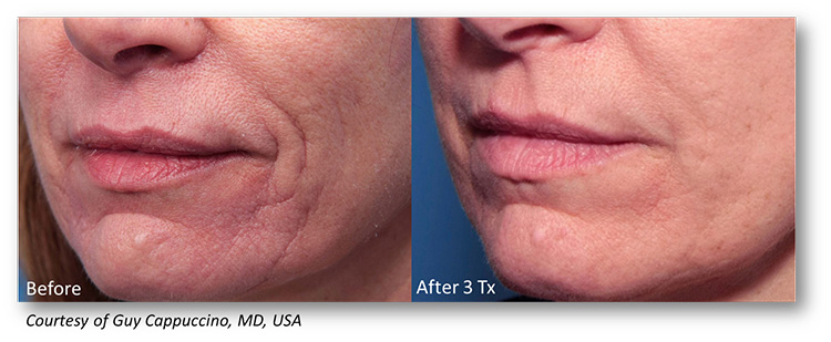 Genius-MicroNeedling-Services-in-Michigan