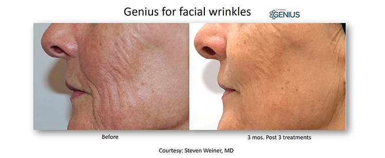 Microneedling-RF-Genius-Services-St-Clair-Shores-MI