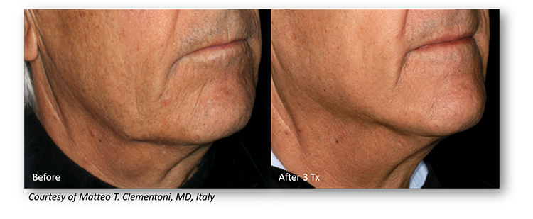 Microneedling-Treatment-in-Michigan-Genius-RF-MN