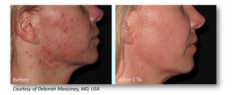 Microneedling-treatment-spa-in-Michigan
