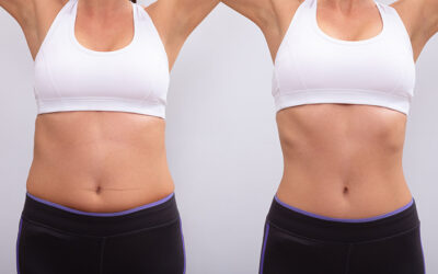 CoolSculpting Elite Takes it to the Next Level